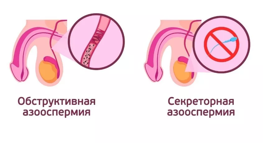 Азооспермия - лечение и диагностика, причины, симптомы | Клиника «Геном» в Ростове-на-Дону